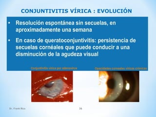 Dr. Frank Rico 36
CONJUNTIVITIS VÍRICA : EVOLUCIÓN
 