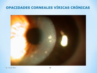 Dr. Frank Rico 38
OPACIDADES CORNEALES VÍRICAS CRÓNICAS
 