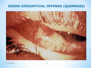 Dr. Frank Rico 41
EDEMA CONJUNTIVAL INTENSO (QUEMOSIS)
 