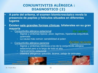 Dr. Frank Rico 42
CONJUNTIVITIS ALÉRGICA :
DIAGNOSTICO (2)
 