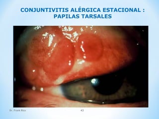 Dr. Frank Rico 43
CONJUNTIVITIS ALÉRGICA ESTACIONAL :
PAPILAS TARSALES
 