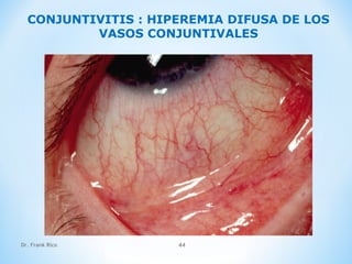 Dr. Frank Rico 44
CONJUNTIVITIS : HIPEREMIA DIFUSA DE LOS
VASOS CONJUNTIVALES
 