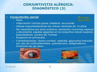 Dr. Frank Rico 45
CONJUNTIVITIS ALÉRGICA:
DIAGNÓSTICO (3)
 