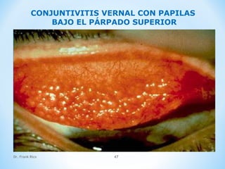 Dr. Frank Rico 47
CONJUNTIVITIS VERNAL CON PAPILAS
BAJO EL PÁRPADO SUPERIOR
 