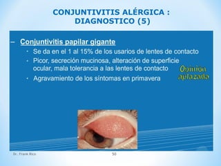 Dr. Frank Rico 50
CONJUNTIVITIS ALÉRGICA :
DIAGNOSTICO (5)
 