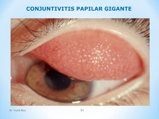 Dr. Frank Rico 51
CONJUNTIVITIS PAPILAR GIGANTE
 
