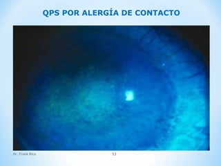 Dr. Frank Rico 53
QPS POR ALERGÍA DE CONTACTO
 