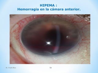 Dr. Frank Rico 58
HIPEMA :
Hemorragia en la cámara anterior.
 