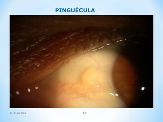 Dr. Frank Rico 62
PINGUÉCULA
 