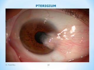 Dr. Frank Rico 63
PTERIGIUM
 