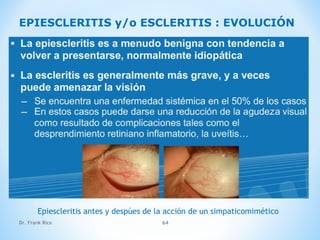 Dr. Frank Rico 64
EPIESCLERITIS y/o ESCLERITIS : EVOLUCIÓN
Epiescleritis antes y despúes de la acción de un simpaticomimético
 