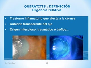 Dr. Frank Rico 65
QUERATITIS : DEFINICIÓN
Urgencia relativa
 
