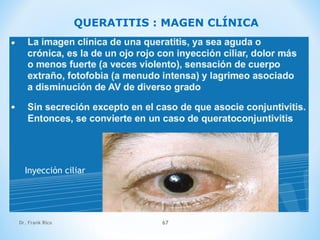Dr. Frank Rico 67
QUERATITIS : MAGEN CLÍNICA
Inyección ciliar
 