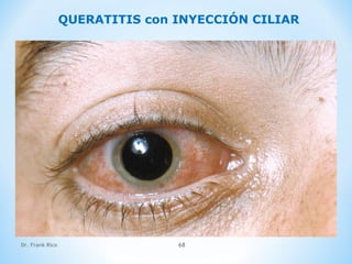 Dr. Frank Rico 68
QUERATITIS con INYECCIÓN CILIAR
 