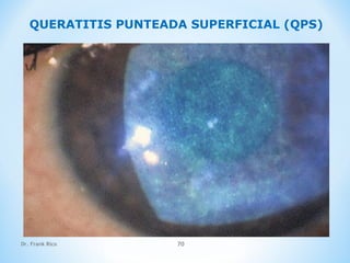 Dr. Frank Rico 70
QUERATITIS PUNTEADA SUPERFICIAL (QPS)
 