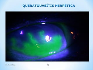 Dr. Frank Rico 72
QUERATOUVEÍTIS HERPÉTICA
 