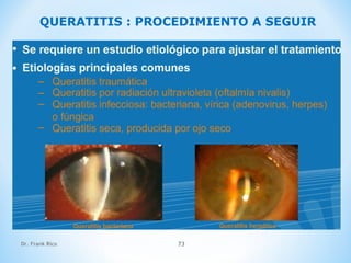 Dr. Frank Rico 73
QUERATITIS : PROCEDIMIENTO A SEGUIR
 
