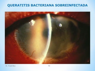 Dr. Frank Rico 74
QUERATITIS BACTERIANA SOBREINFECTADA
 