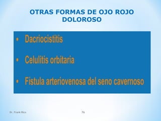 Dr. Frank Rico 76
OTRAS FORMAS DE OJO ROJO
DOLOROSO
 