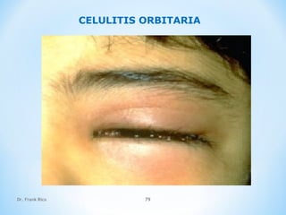 Dr. Frank Rico 79
CELULITIS ORBITARIA
 