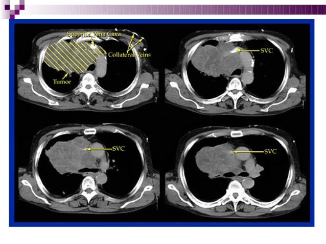 El aplicador a sheynom la osteocondrosis las revocaciones