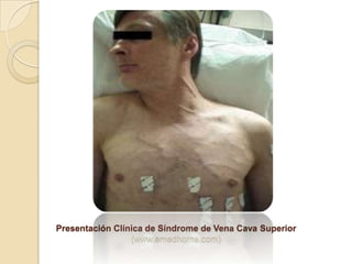 Presentación Clínica de Síndrome de Vena Cava Superior
                 (www.emedhome.com)
 