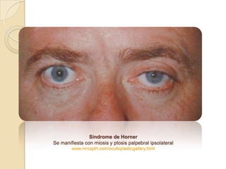 Sindrome de Horner
Se manifiesta con miosis y ptosis palpebral ipsolateral
        www.mrcopth.com/oculloplasticgallery.ht...