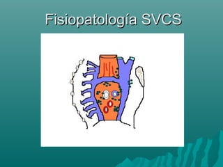Fisiopatología SVCSFisiopatología SVCS
 