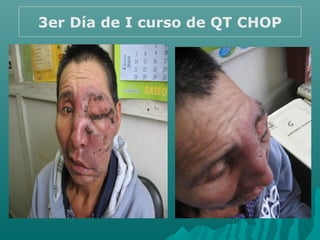 3er Día de I curso de QT CHOP
 