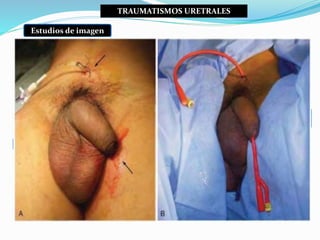 TRAUMATISMOS GENITALES
Las lesiones penetrantes de los genitales externos exigen la exploración
quirúrgica en la inmensa m...