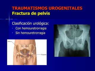 TRAUMATISMOS UROGENITALES Fractura de pelvis <ul><li>Clasificación urológica: </li></ul><ul><li>Con hemouretrorragia </li>...