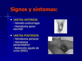 Signos y síntomas: <ul><li>URETRA ANTERIOR: </li></ul><ul><li>- Hemato-uretrorragia </li></ul><ul><li>- Hematoma peno-escr...