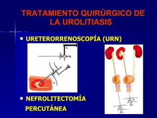 TRATAMIENTO QUIRÚRGICO DE LA UROLITIASIS  <ul><li>URETERORRENOSCOPÍA (URN) </li></ul><ul><li>NEFROLITECTOMÍA  </li></ul><u...
