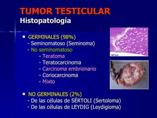 TUMOR TESTICULAR Histopatología <ul><li>GERMINALES (98%) </li></ul><ul><li>- Seminomatoso (Seminoma) </li></ul><ul><li>-  ...