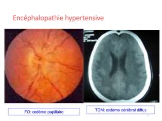 Encéphalopathie hypertensive
17
FO: œdème papillaire TDM: œdème cérébral diffus
 