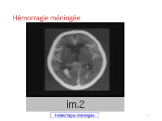 Hémorragie méningée
19Hémorragie méningée
 
