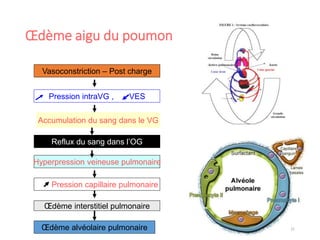 Œdème aigu du poumon
21
Vasoconstriction – Post charge
Accumulation du sang dans le VG
Reflux du sang dans l’OG
Hyperpression veineuse pulmonaire
Pression capillaire pulmonaire
Œdème interstitiel pulmonaire
Œdème alvéolaire pulmonaire
Pression intraVG , VES
 
