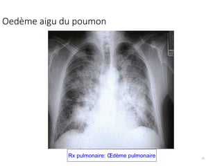23
Oedème aigu du poumon
Rx pulmonaire: Œdème pulmonaire
 