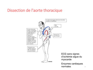 Dissection de l'aorte thoracique
27
ECG sans signes
d’ischémie aigue du
myocarde
Enzymes cardiaques
normales
 