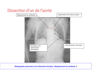 Dissection d'un de l'aorte
28
Radiographie pulmonaire d'une Dissection Aortique (Elargissement du mediastin )
 