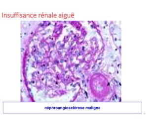 31
Insuffisance rénale aiguë
néphroangiosclérose maligne
 