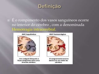  É o rompimento dos vasos sanguíneos ocorre
no interior do cérebro , com a denominada
Hemorragia intracerebral.
 
