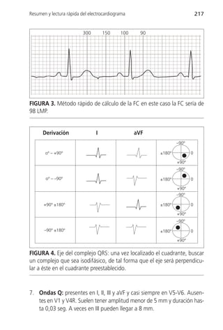 Resumen y lectura rápida del electrocardiograma                             217


                          300       150     100     90




FIGURA 3. Método rápido de cálculo de la FC en este caso la FC sería de
98 LMP.


      Derivación                I                 aVF
                                                                 –90º

       oº – +90º                                         ±180º          0

                                                                 +90º
                                                                 –90º

        oº – –90º                                        ±180º          0

                                                                 +90º
                                                                 –90º

       +90º ±180º                                        ±180º          0

                                                                 +90º
                                                                 –90º

       –90º ±180º                                        ±180º          0

                                                                 +90º


FIGURA 4. Eje del complejo QRS: una vez localizado el cuadrante, buscar
un complejo que sea isodifásico, de tal forma que el eje será perpendicu-
lar a éste en el cuadrante preestablecido.


7. Ondas Q: presentes en I, II, III y aVF y casi siempre en V5-V6. Ausen-
   tes en V1 y V4R. Suelen tener amplitud menor de 5 mm y duración has-
   ta 0,03 seg. A veces en III pueden llegar a 8 mm.
 