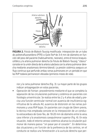 Cardiopatías congénitas                                                      235


                      Arteria subclavia
                          derecha




                           Fístula            Ao




                           Arteria pulmonar
                               derecha

FIGURA 2. Fístula de Blalock-Taussig modificada: interposición de un tubo
de politetrafluoroetileno (PTFE) o Gore-Tex® de 3-4 mm de diámetro en fun-
ción del peso del paciente (habitualmente, neonato), entre el tronco braquio-
cefálico y la arteria pulmonar derecha (la fístula de Blalock-Taussig “clásica”
consiste en la unión directa de la arteria subclavia con la arteria pulmonar dere-
cha mediante anastomosis término-lateral). La presión sistémica asegura un
flujo continuo que perfunde ambas ramas pulmonares en un período en que
las RVP todavía permanecen elevadas (primeros meses de vida).


    rior y la rama pulmonar derecha (Fig. 3). La mayor parte de los grupos
    indican antiagregación en estos pacientes.
•   Operación de Fontan: procedimiento mediante el que se completa la
    separación de las circulaciones pulmonar y sistémica en pacientes con
    fisiología univentricular. Se realiza entre los 2 y 4 años de edad y pre-
    cisa una función ventricular normal con ausencia de insuficiencia sig-
    nificativa de la válvula AV, ausencia de distorsión en las ramas pul-
    monares y unas RVP bajas. En pacientes con cirugía de Glenn previa,
    la técnica más empleada consiste en la interposición de un conduc-
    to extracardiaco de Gore-Tex‚ de 18-20 mm de diámetro entre la vena
    cava inferior y la anastomosis cavopulmonar superior (Fig. 4). En esta
    situación, todo el retorno venoso sistémico alcanza la circulación pul-
    monar de manera pasiva “sin pasar por el corazón”. En determina-
    das situaciones y en función de la preferencia de los centros, en el
    conducto se realiza una fenestración a la aurícula derecha que per-
 