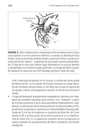 236                                           B. Toral Vázquez, M.A. Granados Ruiz




                 Arteria pulmonar   VCS
                     derecha
                                               Ao




FIGURA 3. Glenn bidireccional: anastomosis término-lateral entre la vena
cava superior y la rama pulmonar derecha. La sangre se distribuye hacia
ambas ramas pulmonares (bidireccional) y alcanza el lecho vascular pul-
monar de forma “pasiva”, a expensas de una presión venosa central eleva-
da. El flujo de la vena cava inferior sigue drenando en la aurícula derecha
y mezclándose con el retorno venoso pulmonar. La cirugía de Glenn no pue-
de realizarse en pacientes con RVP elevadas (primeros meses de vida).


      mite la descarga de presión en el circuito, a cambio de cierto grado
      de desaturación. La circulación de Fontan presenta un riesgo eleva-
      do de trombosis venosa (hasta un 20-30%) por lo que la mayoría de
      los grupos indican anticoagulación durante al menos los primeros 6
      meses.
•     Cirugía de Norwood: procedimiento empleado en neonatos con hipo-
      plasia de cavidades izquierdas para construir una “neoaorta” a partir
      de la arteria pulmonar y de la aorta ascendente (habitualmente, hipo-
      plásica). La bifurcación de la arteria pulmonar es desconectada y el flu-
      jo pulmonar se garantiza a través de una fístula de Blalock-Taussig modi-
      ficada de 3,5-4 mm (o mediante un conducto de Gore-Tex‚ de 5 mm
      desde el VD a la bifurcación de la arteria pulmonar en la modifica-
      ción de Sano) (Fig. 5). La separación posterior de las circulaciones se
      realiza mediante los procedimientos de Glenn (estadio II) y de Fontan
      (estadio III).
 