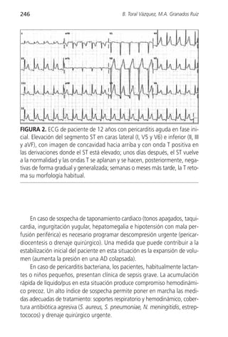 246                                           B. Toral Vázquez, M.A. Granados Ruiz




FIGURA 2. ECG de paciente de 12 años con pericarditis aguda en fase ini-
cial. Elevación del segmento ST en caras lateral (I, V5 y V6) e inferior (II, III
y aVF), con imagen de concavidad hacia arriba y con onda T positiva en
las derivaciones donde el ST está elevado; unos días después, el ST vuelve
a la normalidad y las ondas T se aplanan y se hacen, posteriormente, nega-
tivas de forma gradual y generalizada; semanas o meses más tarde, la T reto-
ma su morfología habitual.




    En caso de sospecha de taponamiento cardiaco (tonos apagados, taqui-
cardia, ingurgitación yugular, hepatomegalia e hipotensión con mala per-
fusión periférica) es necesario programar descompresión urgente (pericar-
diocentesis o drenaje quirúrgico). Una medida que puede contribuir a la
estabilización inicial del paciente en esta situación es la expansión de volu-
men (aumenta la presión en una AD colapsada).
    En caso de pericarditis bacteriana, los pacientes, habitualmente lactan-
tes o niños pequeños, presentan clínica de sepsis grave. La acumulación
rápida de líquido/pus en esta situación produce compromiso hemodinámi-
co precoz. Un alto índice de sospecha permite poner en marcha las medi-
das adecuadas de tratamiento: soportes respiratorio y hemodinámico, cober-
tura antibiótica agresiva (S. aureus, S. pneumoniae, N. meningitidis, estrep-
tococos) y drenaje quirúrgico urgente.
 