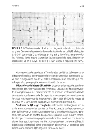 Arritmias                                                                  255




FIGURA 5. ECG de varón de 14 años con diagnóstico de MH no obstructi-
va grave. Demuestra la presencia de una desviación del eje del QRS a la izquier-
da (- 30º) con ondas Q patológicas en III y aVF y S profunda en precordia-
les. Además, llama mucho la atención la alteración de la repolarización con
ascenso del ST en III y AVF, eje de T a + 120º y onda T negativa en I y aVL.



     Algunas entidades asociadas a TV en la edad pediátrica deben ser cono-
cidas por el pediatra que trabaja en la sección de urgencias dado que la cla-
ve para el diagnóstico puede ser el ECG realizado en un paciente que con-
sulta por síncope o palpitaciones en situación de estrés:
     Miocardiopatía hipertrófica (MH): grupo de enfermedades con hete-
rogeneidad genética y variabilidad fenotípica. Las áreas de fibrosis (myocy-
te disarray) favorecen el establecimiento de arritmias ventriculares a través
de mecanismos de reentrada. En deportistas de competición americanos es
la causa más frecuente de muerte súbita (36-42%). El ECG de reposo es
anormal en > 90% de los casos de MH hipertrófica grave (Fig. 5).
     Síndrome de QT largo congénito: enfermedad arritmogénica secun-
daria a mutaciones en los canales de Na y K, caracterizada por prolonga-
ción del intervalo QT en el ECG de superficie y arritmias ventriculares, gene-
ralmente torsade de pointes. Los pacientes con QT largo pueden presen-
tar síncope, convulsiones o palpitaciones durante el ejercicio o con las emo-
ciones intensas. La primera manifestación puede ser la muerte súbita. El
diagnóstico se establece por la prolongación del intervalo QT corregido para
la frecuencia cardiaca (QTc) según la fórmula de Bazet.
 