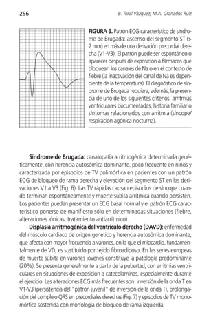 256                                           B. Toral Vázquez, M.A. Granados Ruiz


                                FIGURA 6. Patrón ECG característico de síndro-
                                me de Brugada: ascenso del segmento ST (>
                                2 mm) en más de una derivación precordial dere-
                                cha (V1-V3). El patrón puede ser espontáneo o
                                aparecer después de exposición a fármacos que
                                bloquean los canales de Na o en el contexto de
                                fiebre (la inactivación del canal de Na es depen-
                                diente de la temperatura). El diagnóstico de sín-
                                drome de Brugada requiere, además, la presen-
                                cia de uno de los siguientes criterios: arritmias
                                ventriculares documentadas, historia familiar o
                                síntomas relacionados con arritmia (síncope/
                                respiración agónica nocturna).




     Síndrome de Brugada: canalopatía arritmogénica determinada gené-
ticamente, con herencia autosómica dominante, poco frecuente en niños y
caracterizada por episodios de TV polimórfica en pacientes con un patrón
ECG de bloqueo de rama derecha y elevación del segmento ST en las deri-
vaciones V1 a V3 (Fig. 6). Las TV rápidas causan episodios de síncope cuan-
do terminan espontáneamente y muerte súbita arrítmica cuando persisten.
Los pacientes pueden presentar un ECG basal normal y el patrón ECG carac-
terístico ponerse de manifiesto sólo en determinadas situaciones (fiebre,
alteraciones iónicas, tratamiento antiarrítmico).
     Displasia arritmogénica del ventrículo derecho (DAVD): enfermedad
del músculo cardiaco de origen genético y herencia autosómica dominante,
que afecta con mayor frecuencia a varones, en la que el miocardio, fundamen-
talmente de VD, es sustituido por tejido fibroadiposo. En las series europeas
de muerte súbita en varones jóvenes constituye la patología predominante
(20%). Se presenta generalmente a partir de la pubertad, con arritmias ventri-
culares en situaciones de exposición a catecolaminas, especialmente durante
el ejercicio. Las alteraciones ECG más frecuentes son: inversión de la onda T en
V1-V3 (persistencia del “patrón juvenil” de inversión de la onda T), prolonga-
ción del complejo QRS en precordiales derechas (Fig. 7) y episodios de TV mono-
mórfica sostenida con morfología de bloqueo de rama izquierda.
 
