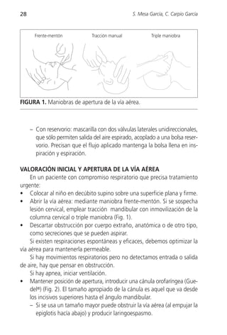 28                                               S. Mesa García, C. Carpio García



       Frente-mentón           Tracción manual            Triple maniobra




FIGURA 1. Maniobras de apertura de la vía aérea.



     – Con reservorio: mascarilla con dos válvulas laterales unidireccionales,
       que sólo permiten salida del aire espirado, acoplado a una bolsa reser-
       vorio. Precisan que el flujo aplicado mantenga la bolsa llena en ins-
       piración y espiración.

VALORACIÓN INICIAL Y APERTURA DE LA VÍA AÉREA
     En un paciente con compromiso respiratorio que precisa tratamiento
urgente:
• Colocar al niño en decúbito supino sobre una superficie plana y firme.
• Abrir la vía aérea: mediante maniobra frente-mentón. Si se sospecha
     lesión cervical, emplear tracción mandibular con inmovilización de la
     columna cervical o triple maniobra (Fig. 1).
• Descartar obstrucción por cuerpo extraño, anatómica o de otro tipo,
     como secreciones que se pueden aspirar.
     Si existen respiraciones espontáneas y eficaces, debemos optimizar la
vía aérea para mantenerla permeable.
     Si hay movimientos respiratorios pero no detectamos entrada o salida
de aire, hay que pensar en obstrucción.
     Si hay apnea, iniciar ventilación.
• Mantener posición de apertura, introducir una cánula orofaríngea (Gue-
     del®) (Fig. 2). El tamaño apropiado de la cánula es aquel que va desde
     los incisivos superiores hasta el ángulo mandibular.
     – Si se usa un tamaño mayor puede obstruir la vía aérea (al empujar la
        epiglotis hacía abajo) y producir laringoespasmo.
 