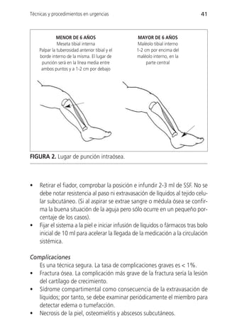 Técnicas y procedimientos en urgencias                                        41



              MENOR DE 6 AÑOS                    MAYOR DE 6 AÑOS
              Meseta tibial interna              Maléolo tibial interno
    Palpar la tuberosidad anterior tibial y el   1-2 cm por encima del
    borde interno de la misma. El lugar de       maléolo interno, en la
     punción será en la línea media entre             parte central
     ambos puntos y a 1-2 cm por debajo




FIGURA 2. Lugar de punción intraósea.



•   Retirar el fiador, comprobar la posición e infundir 2-3 ml de SSF. No se
    debe notar resistencia al paso ni extravasación de líquidos al tejido celu-
    lar subcutáneo. (Si al aspirar se extrae sangre o médula ósea se confir-
    ma la buena situación de la aguja pero sólo ocurre en un pequeño por-
    centaje de los casos).
•   Fijar el sistema a la piel e iniciar infusión de líquidos o fármacos tras bolo
    inicial de 10 ml para acelerar la llegada de la medicación a la circulación
    sistémica.

Complicaciones
   Es una técnica segura. La tasa de complicaciones graves es < 1%.
• Fractura ósea. La complicación más grave de la fractura sería la lesión
   del cartílago de crecimiento.
• Sídrome compartimental como consecuencia de la extravasación de
   líquidos; por tanto, se debe examinar periódicamente el miembro para
   detectar edema o tumefacción.
• Necrosis de la piel, osteomielitis y abscesos subcutáneos.
 